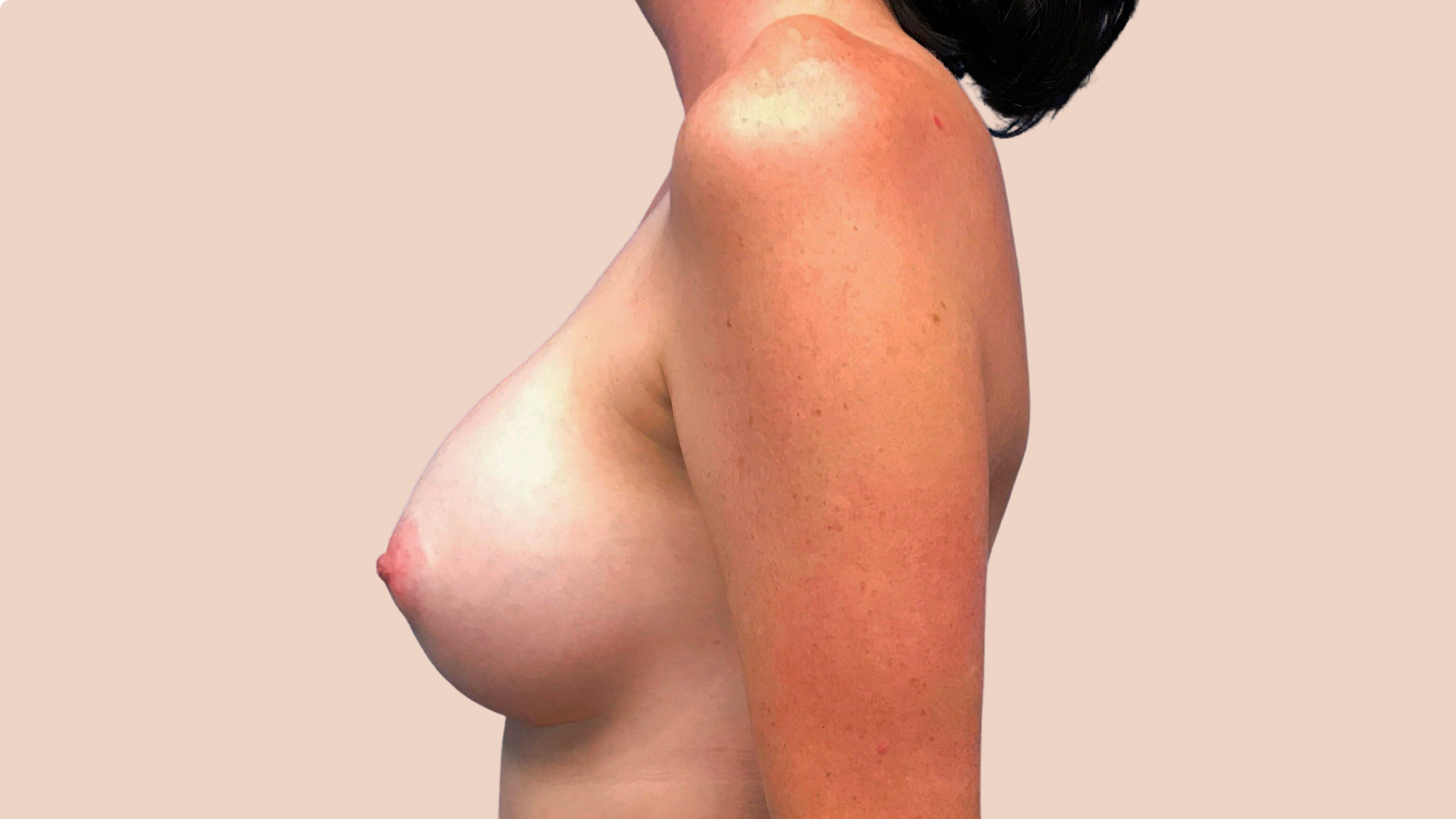Breast Augmentation after image