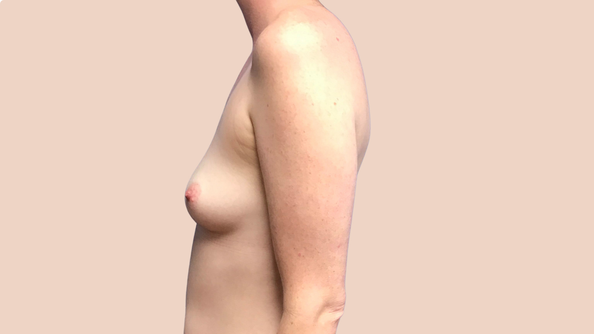 Breast Augmentation before image