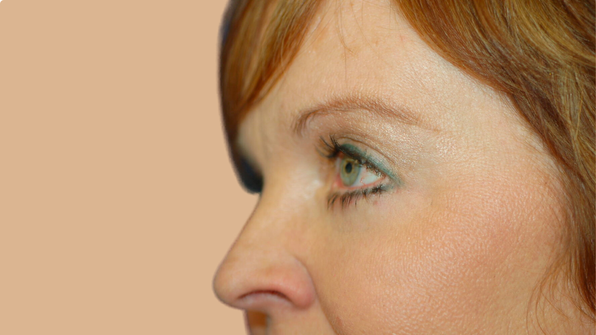 Eyelid Lift after image