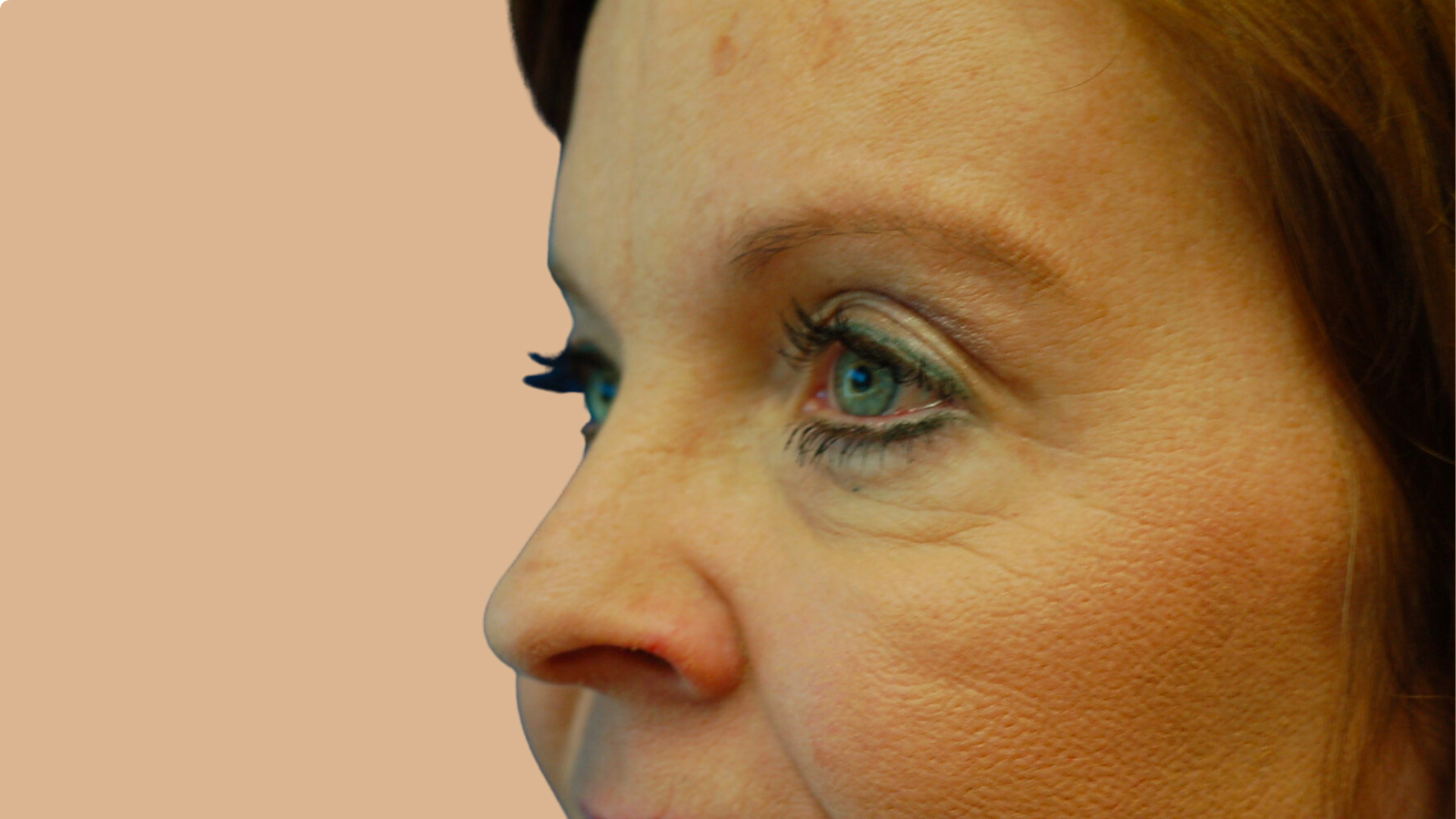 Eyelid Lift before image