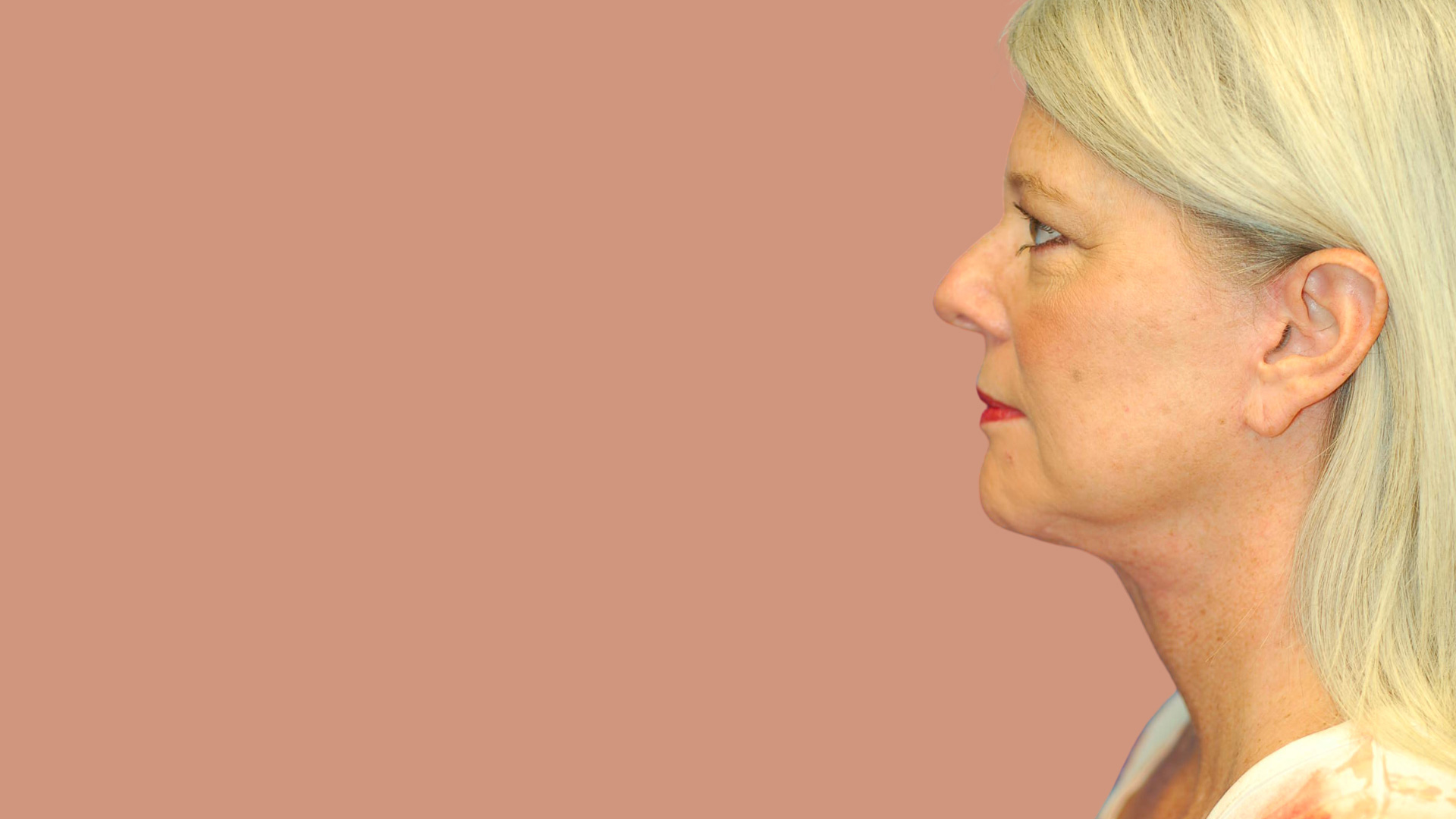Facelift after image