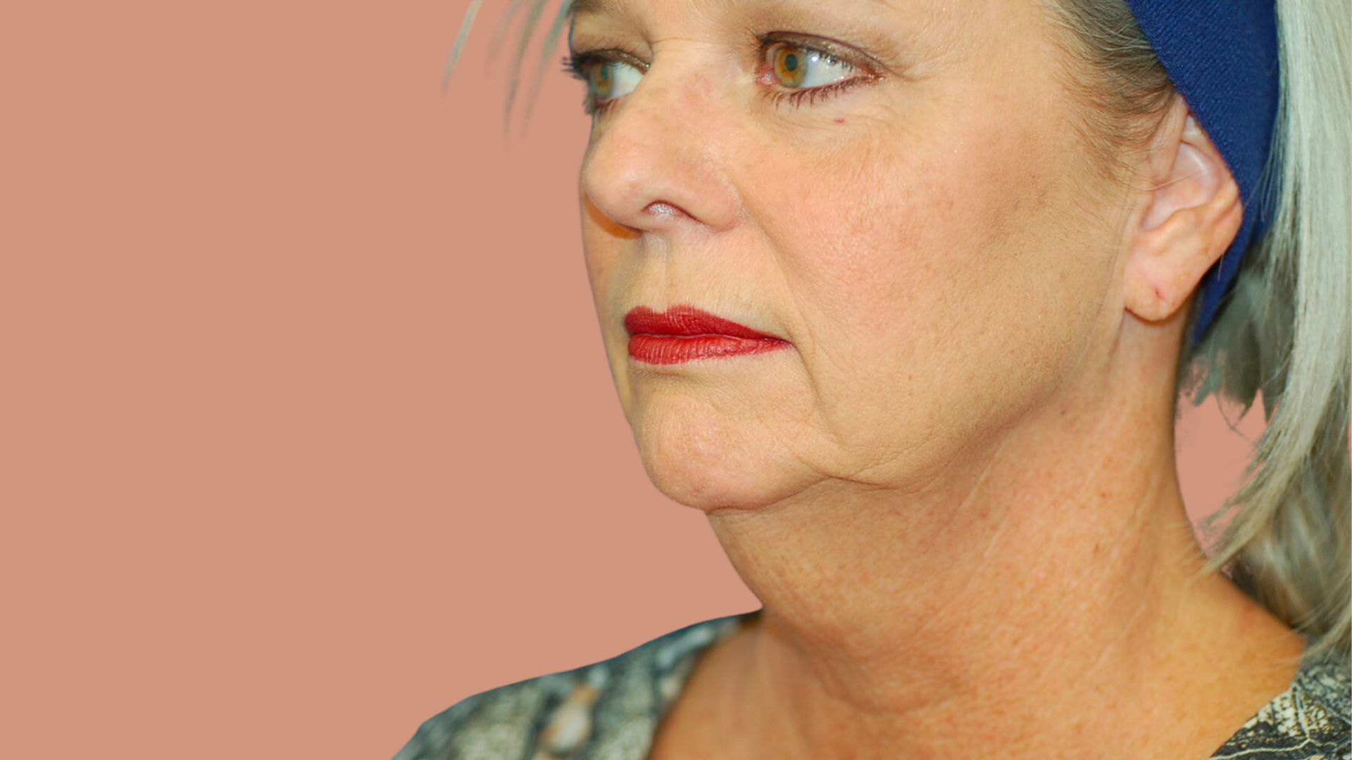 Facelift before image