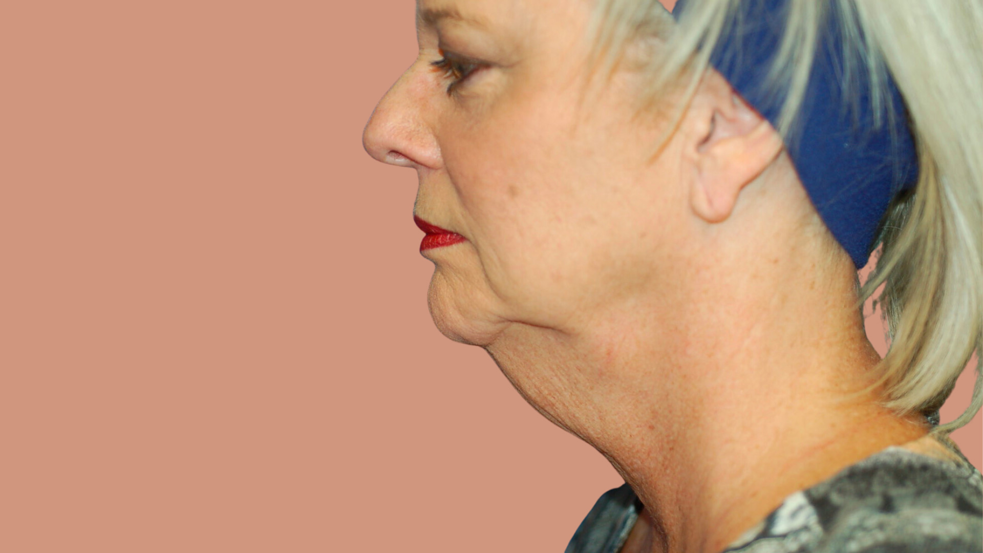 Facelift before image