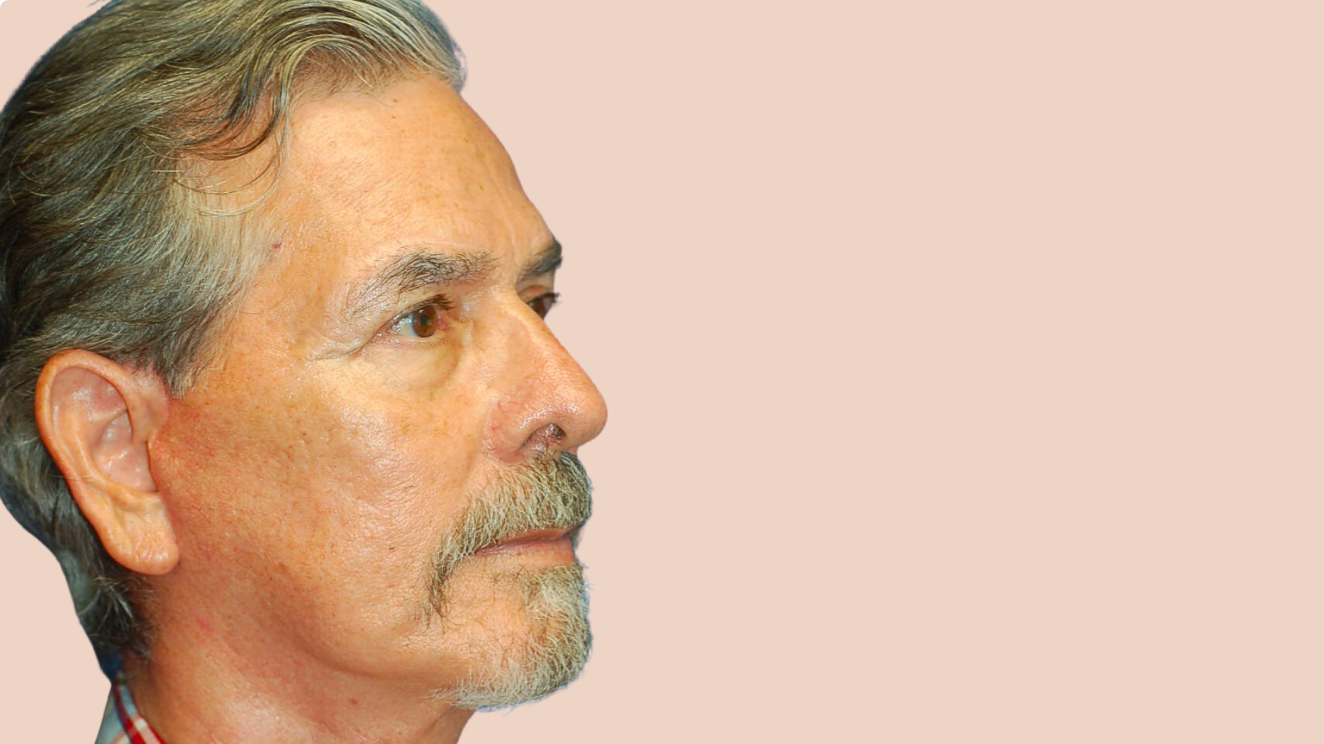 Facelift after image
