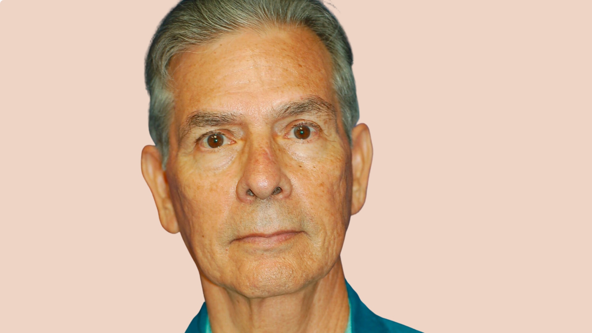 Facelift before image