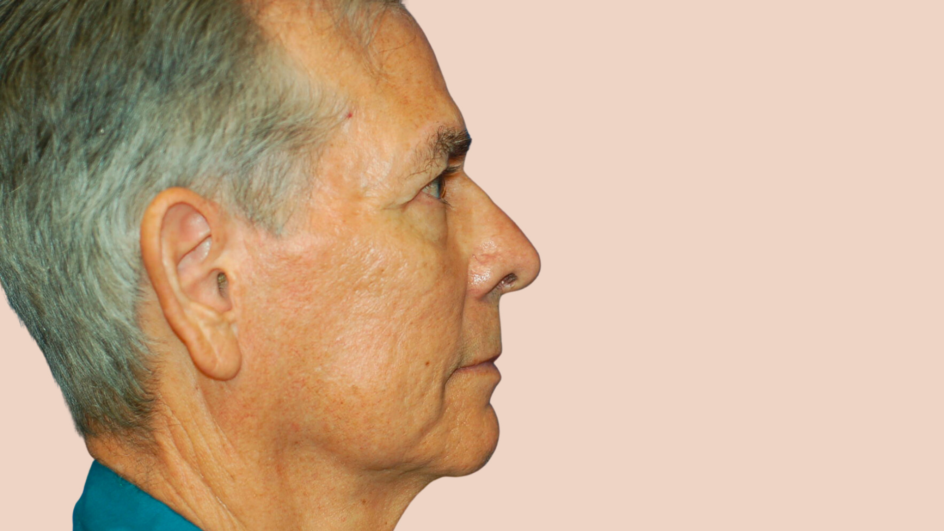 Facelift before image