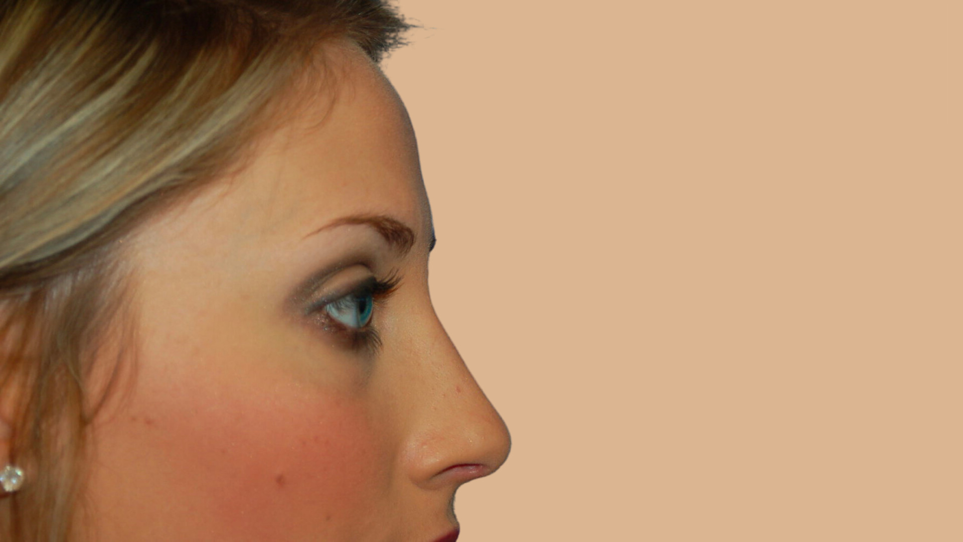 Rhinoplasty after image