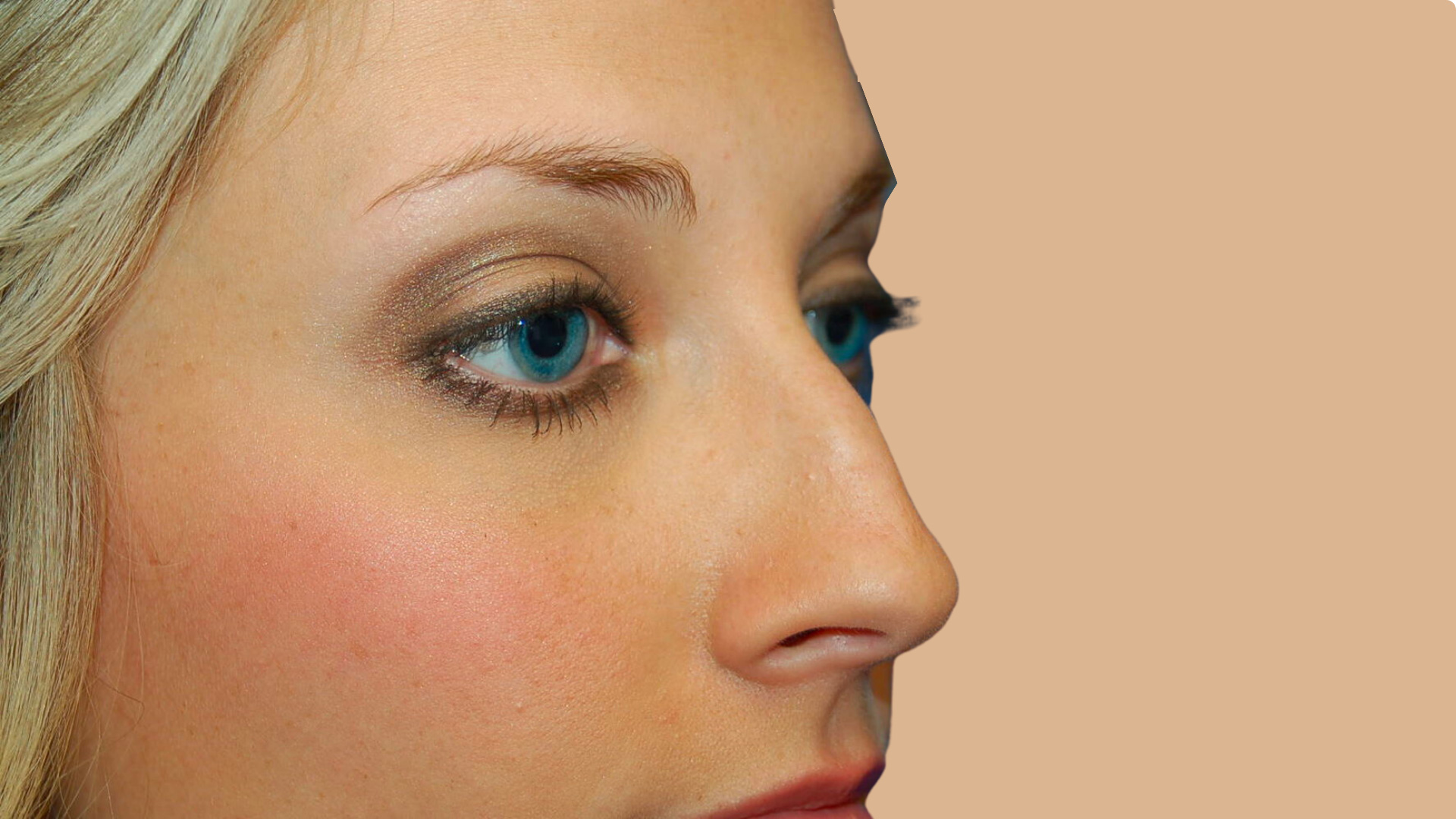 Rhinoplasty before image