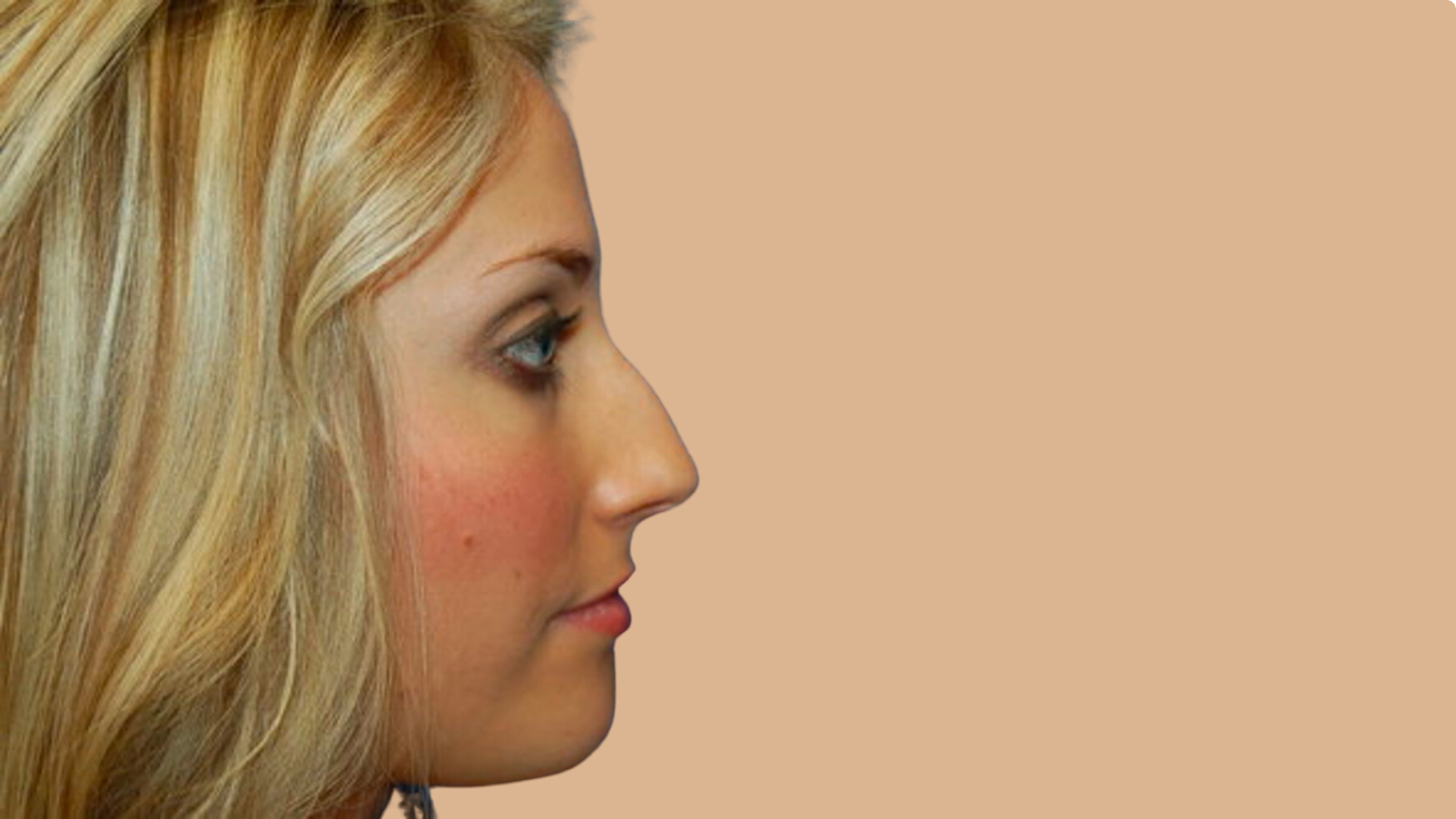 Rhinoplasty before image