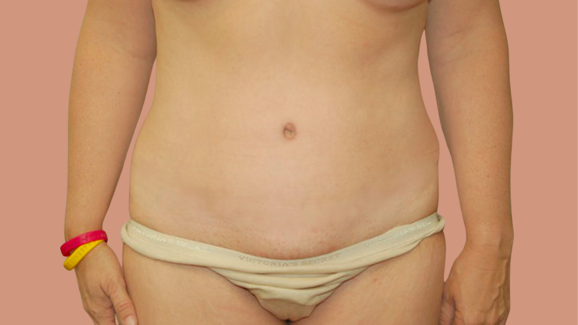 Tummy Tuck after image
