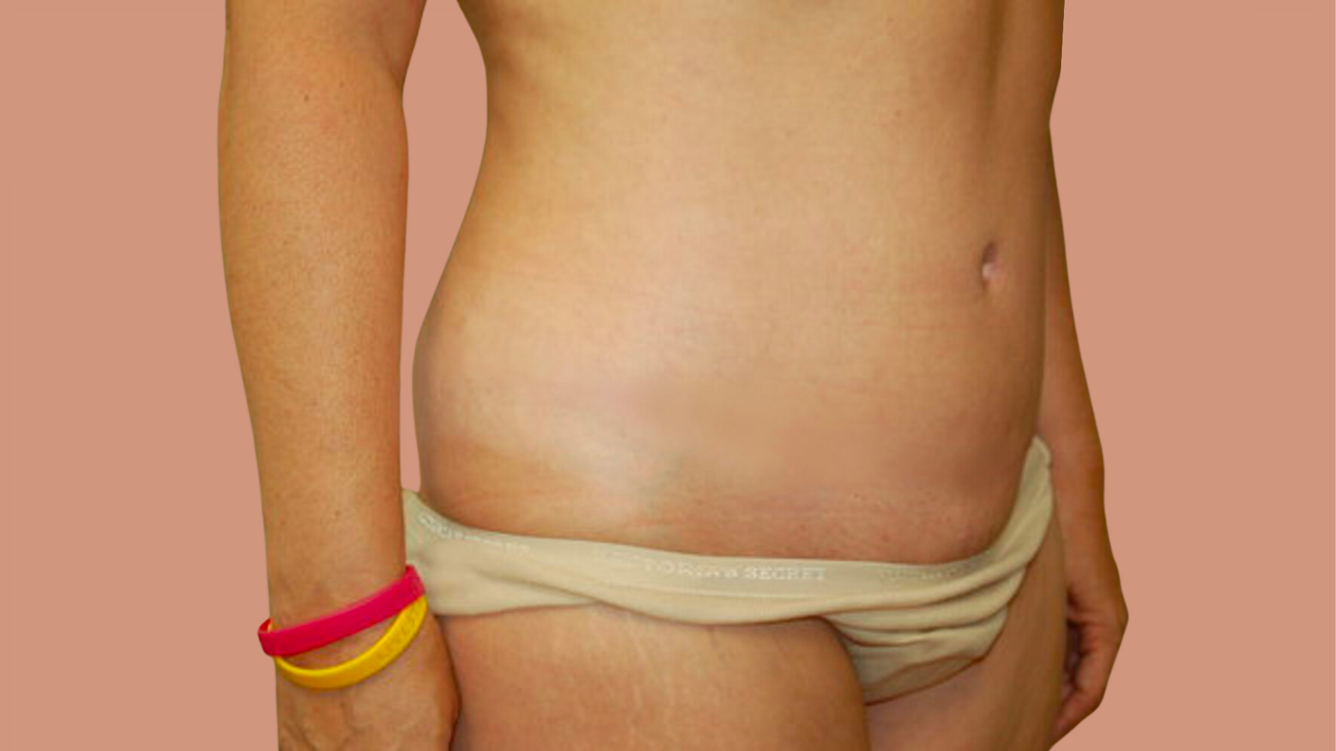 Tummy Tuck after image
