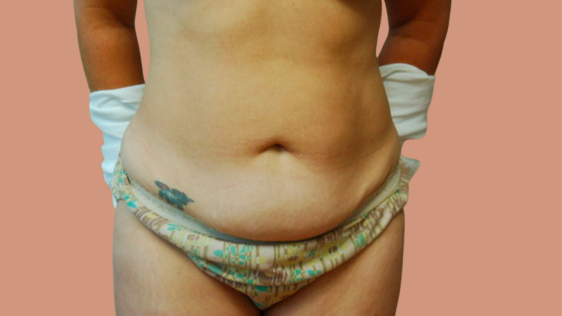 Tummy Tuck before image