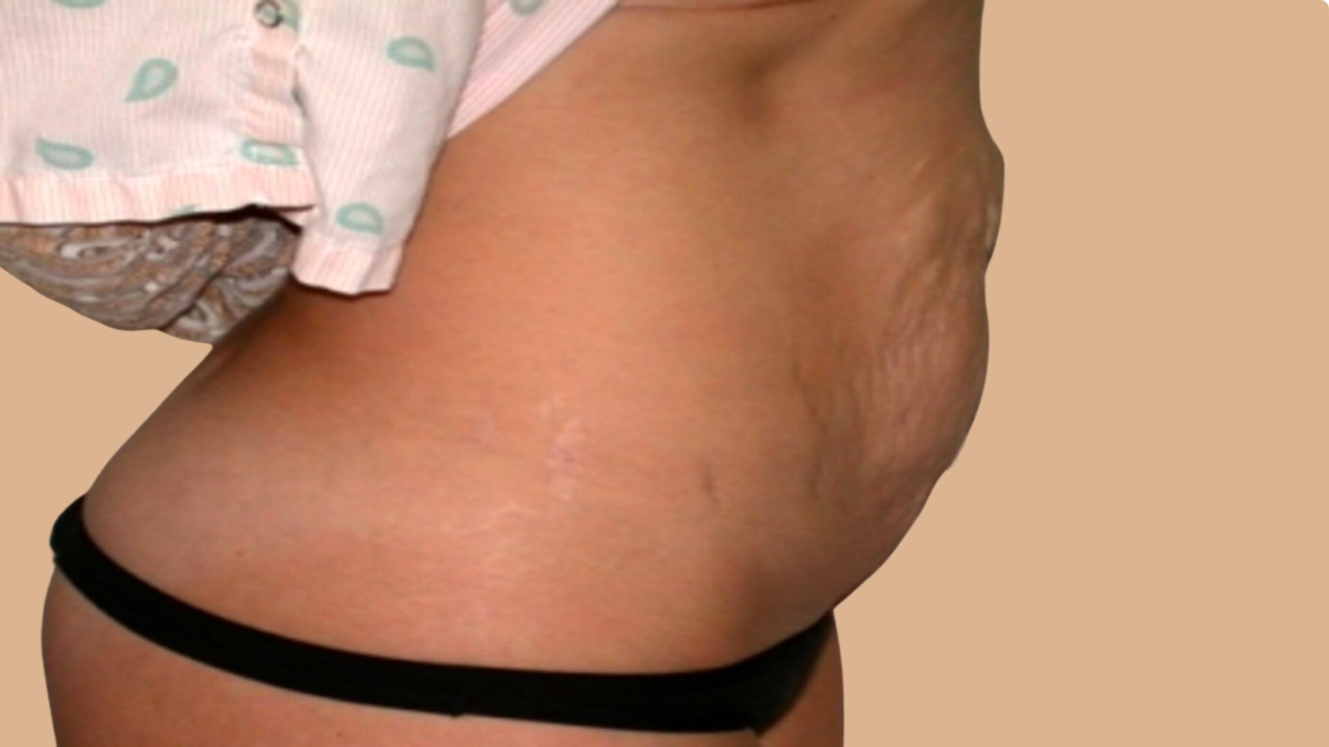 Tummy Tuck before image