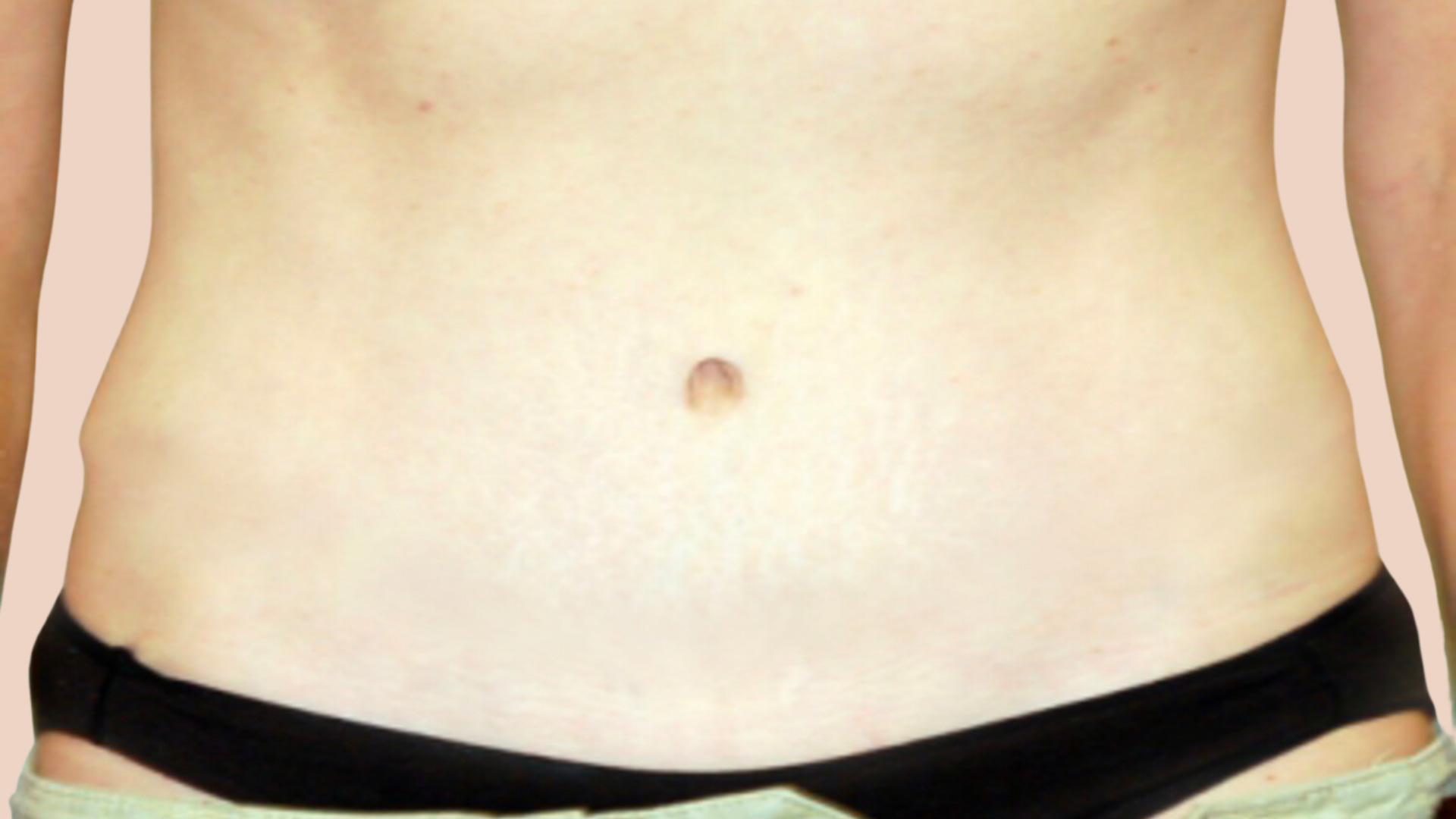 Tummy Tuck after image
