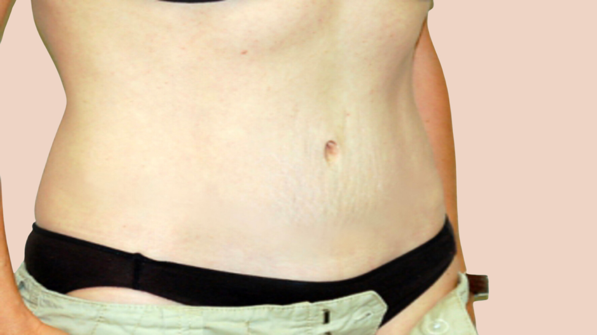 Tummy Tuck after image