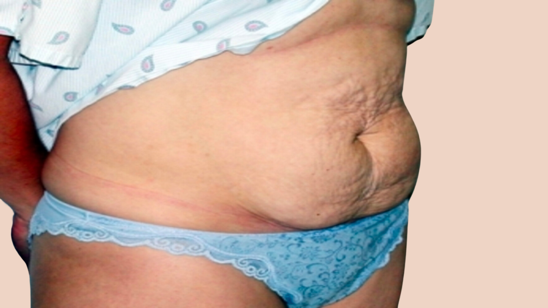 Tummy Tuck before image